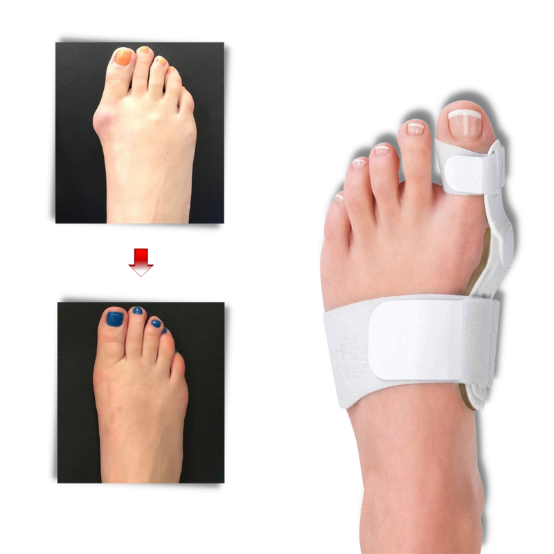 Orthopaedic Bunion Corrector