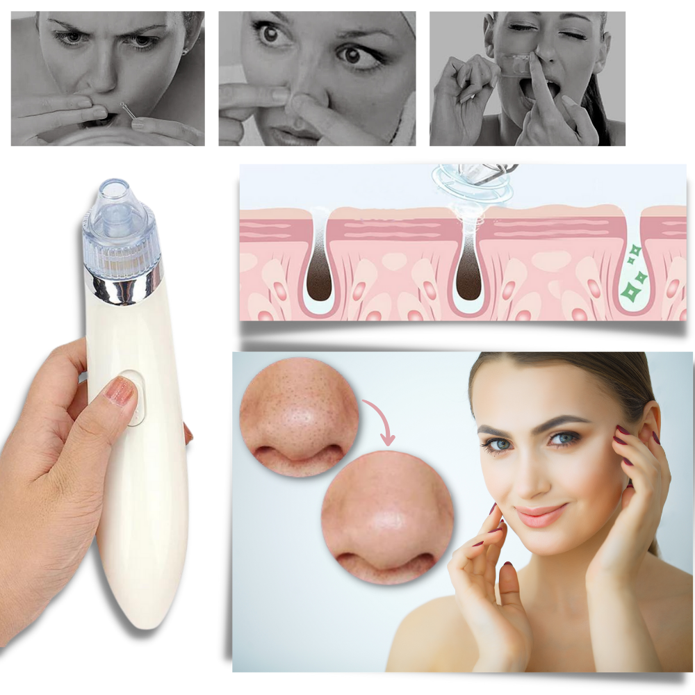 Facial Blackhead Remover Set - Ozerty